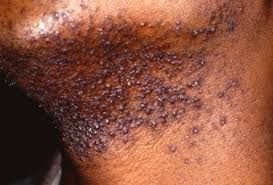 RAZOR BUMPS EXPLAINED