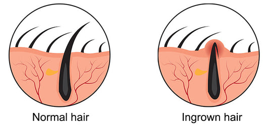 TACKLING BEARD KNOTS & INGROWNS